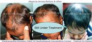 Alopecia Areata Treatment in Pondicherry 