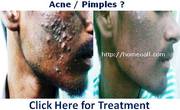 Pimples - Acne Treatment in Pondicherry