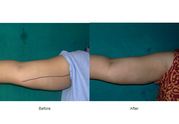 Best Arm lift Surgery Clinic in Ahmadabad,  India