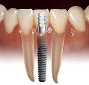 Cheap Denta Implants India- Dental Tour India 