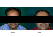 Best Hair Transplantation Surgeon in Ahmedabad