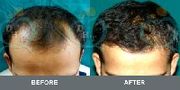 Hair Transplant