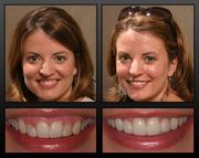 Get a Smile Makeover by Cosmetic Dentistry in Delhi
