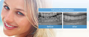 Make a good smile by full Mouth Rehabilitation in Delhi
