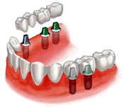 Dental Implant India | Affordable Dental Implant in india| Dental Tour