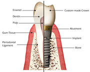 affordable dental implant surgery cost, DENTAL IMPLANT TRAINING COURSE 