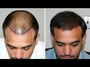 Hair Transplant Treatment
