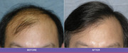 Hair transplant centre in Delhi | hair transplant cost in delhi