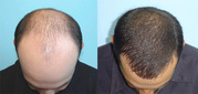 Hair transplant centre near himachal pardesh | at affordable cost