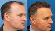 cost of hair transplant | hair transplant near jammu & kashmir