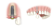 Get Best Dental implant services in Delhi, India