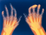 ayurvedic treatment for rheumatoid arthritis
