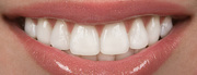 Best Porcelain Veneers in Delhi
