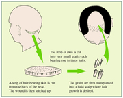 Best Hair Transplant in Ahmedabad