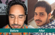 Hair Transplant in Ludhiana