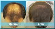 Hair Transplant in Jalandhar