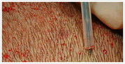 Modern Hair transplant & Hair transplant procedure 