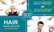 Top 9 Ways That Make Your Hair Transplant Decision Easier