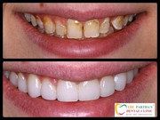 Best Dental Clinic in Bhubaneswar for Laser Dentistry,  Teeth Whitening