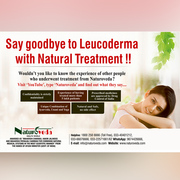 Say goodbye to Leucoderma with natural treatment!