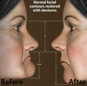 Dental Implants & Full Mouth Restorations in Gurgaon