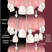 Best Dental Implants in Hyderabad - Dental Implants Cost in Hyderabad