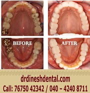 Best Root Canal Treatment In Secunderabad | Dinesh's Dental Paradise
