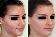 Get Clear and Glowing Skin with Best Acne Treatment in Delhi