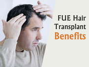 Best Hair Transplant in Hyderabad | Hitech City 