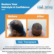 hair transplantation services