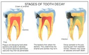 Finding Root Canal Treatment in Gurgaon