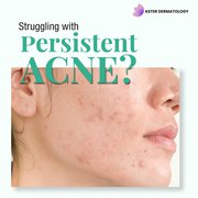 Acne Scars Treatment in Gurgaon