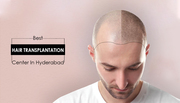 Hair transplantation treatment