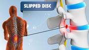 You want to Slip disc treatment in Delhi