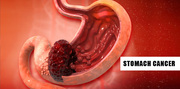 Stomach/Gastric Cancer Treatment in Delhi,  Gurugram,  Gurgaon