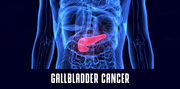 Gallbladder Stone Treatment in Delhi,  Gurugram,  Gurgaon