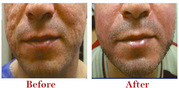Dermal fillers cost in delhi