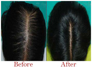 Best Hair Transplant Surgeon in Delhi