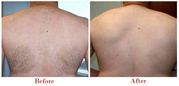 Laser Hair Removal in South Delhi