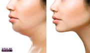 HIFU treatment cost in Delhi