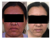 Face Lift Surgery in Delhi