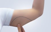 All the facts about Arm Lifts ( Brachioplasty ) Surgery