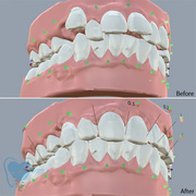 Invisible Clear Aligners for Misaligned Teeth in Tamilnadu