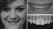 Teeth Whitening & Cleaning In Ahmedabad