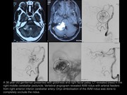 Complete cure of  ruptured cerebellar AVM by endovascular embolisation