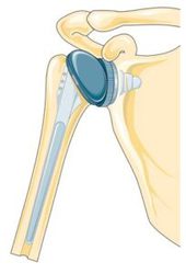 Shoulder Joint Replacement Surgery in Hyderabad 