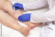  Block blood flow treatment in Coimbatore  | Sri Ramakrishna Hospital