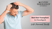 Top 5 Hair Transplant Clinic in Chandigarh