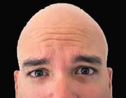 IHR BALDNESS Treatment at Indiranagar/New Thippasandra