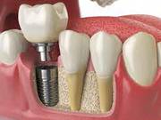 Dental implants in india